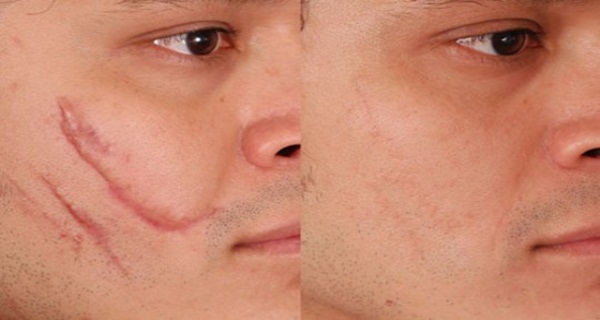 Home-Remedies-For-Scar-Removal.jpg